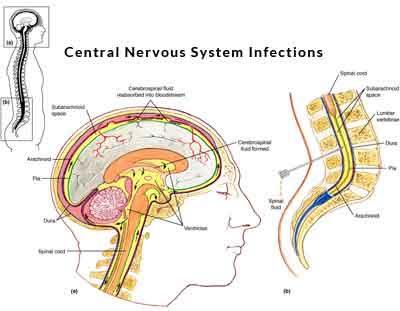 central-nervous-system-infections